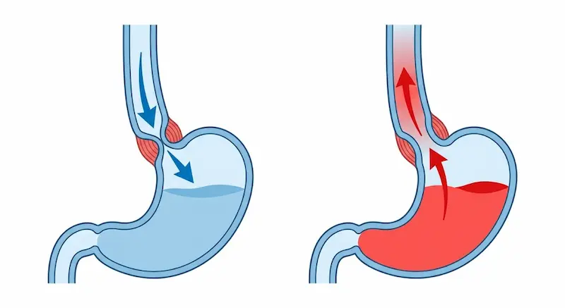 역류성 식도염 발생 원리 — 하부식도괄약근의 역할 하부식도괄약근 정상 작동과 역류 발생 비교 일러스트