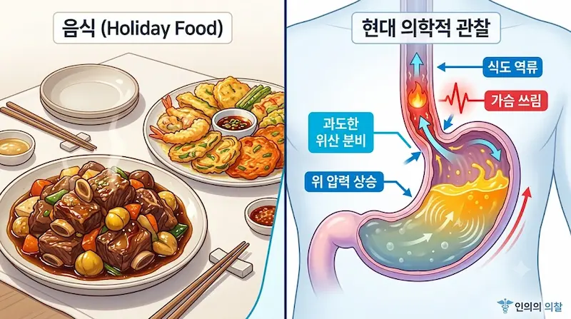 기름진 고지방 명절 음식과 위 내부 압력 상승 및 위산 과다 분비로 인한 속 쓰림 과정을 대비하여 보여주는 메디컬 인포그래픽.