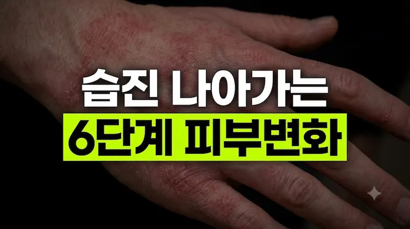 습진 나아가는 6단계 피부 변화와 치유 과정 대표 썸네일